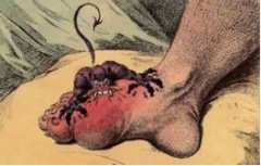 骨科健康 | 痛风久治不愈能有多痛？