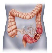 康静波教授：身体有这5大症状，可能是直肠癌早期信号，有癌变可能！