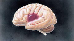 关于脑肿瘤治疗，听听肿瘤放疗专家康静波教授怎么讲