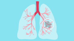 这些比癌细胞还可怕的肺癌并发症，权威专家康静波教授提醒你这样预防！