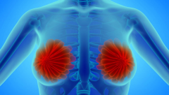 知名肿瘤专家康静波教授提醒：乳腺癌有3大并发症，稍不留神会出大问题！